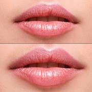 Injectable Fillers