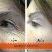 Dysport / Botox